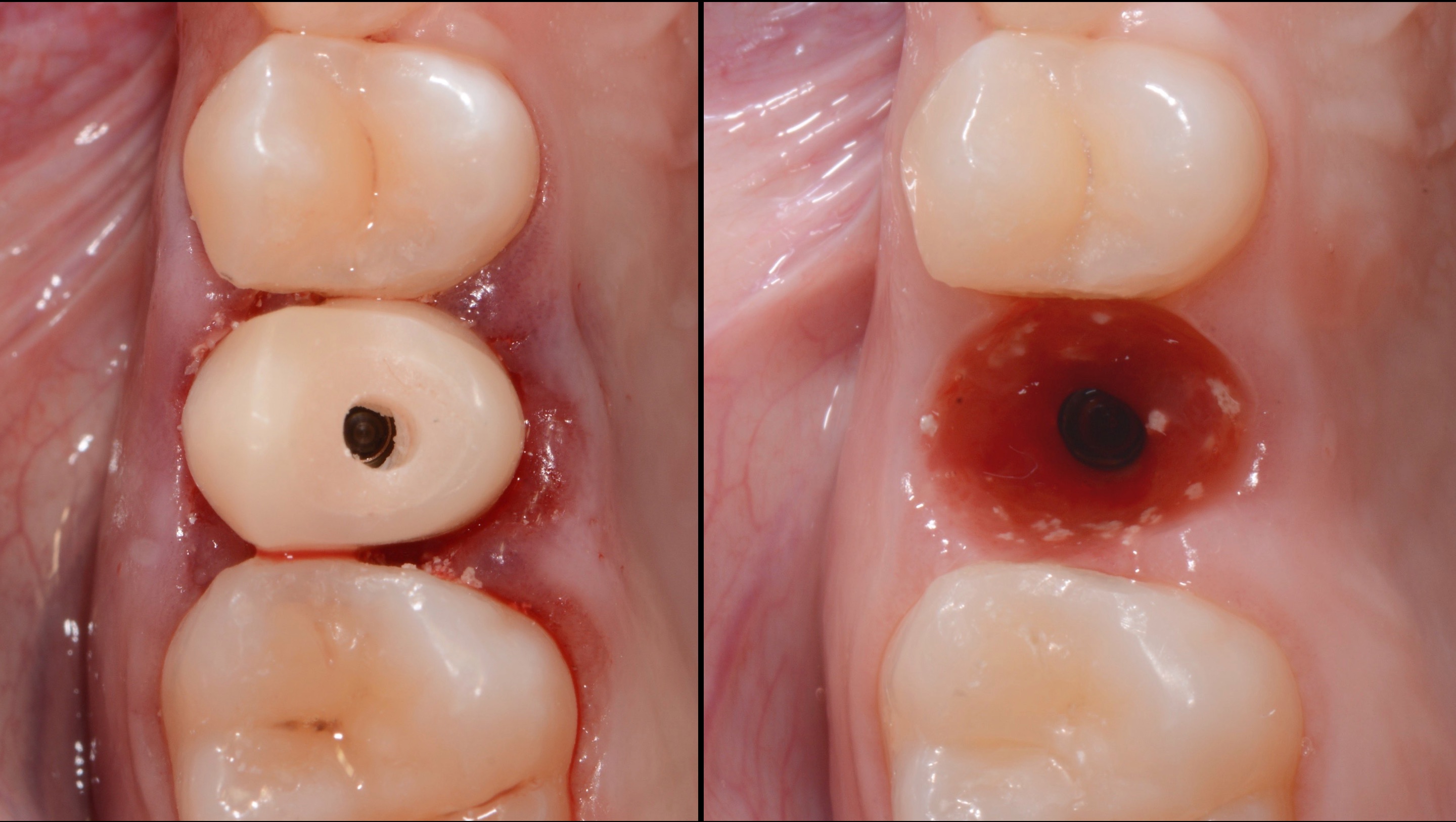 Immediate Implant Placement And Immediate Loading On Premolar Site Step By Step Procedure 