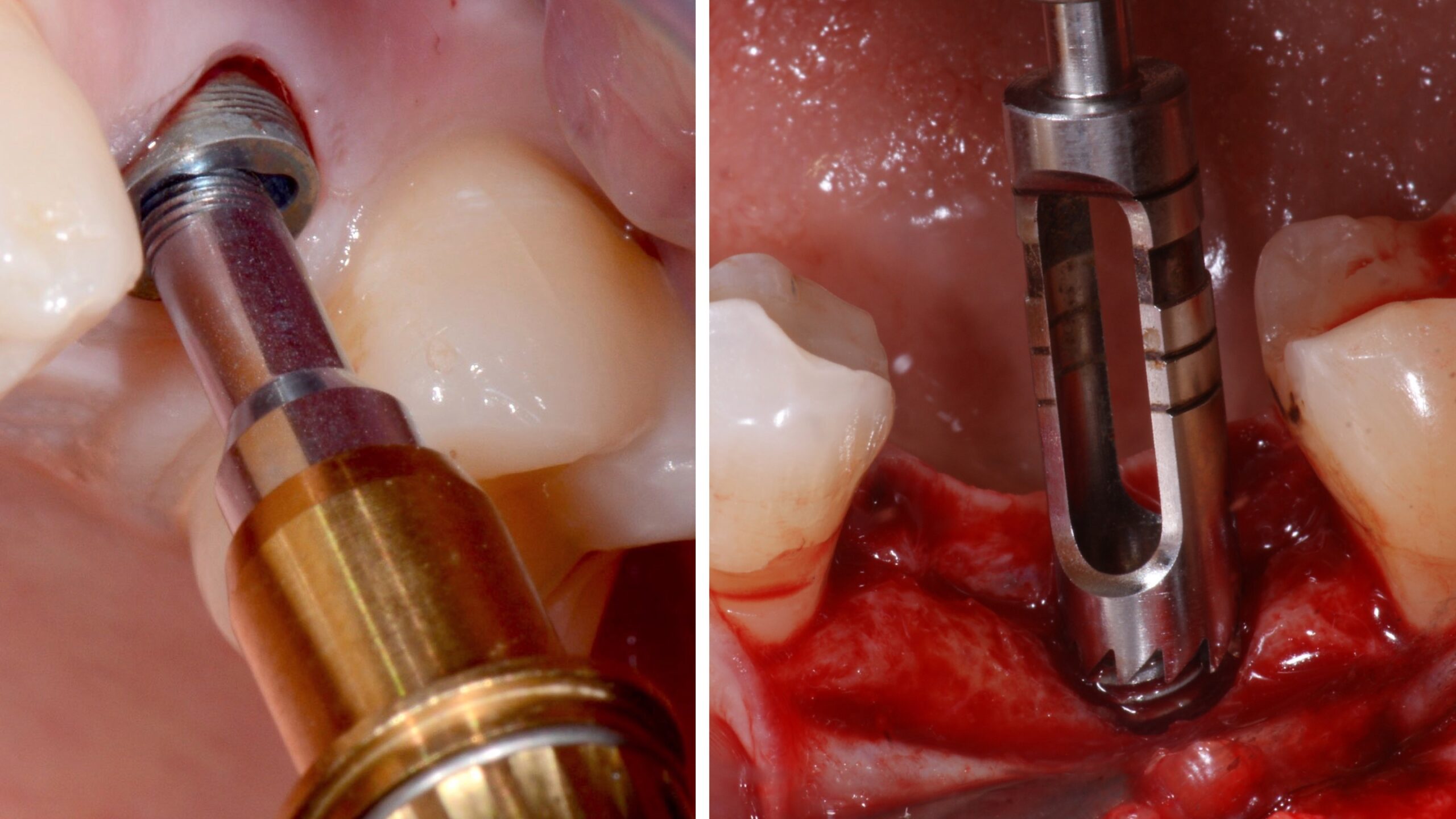 INTEGRATED IMPLANT REMOVAL PREDICTABLE PROTOCOL AND SAFE TECHNIQUE 