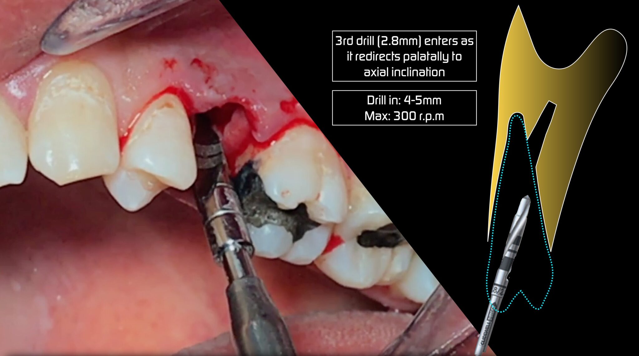 8 important factors to consider at the time of immediate implant ...