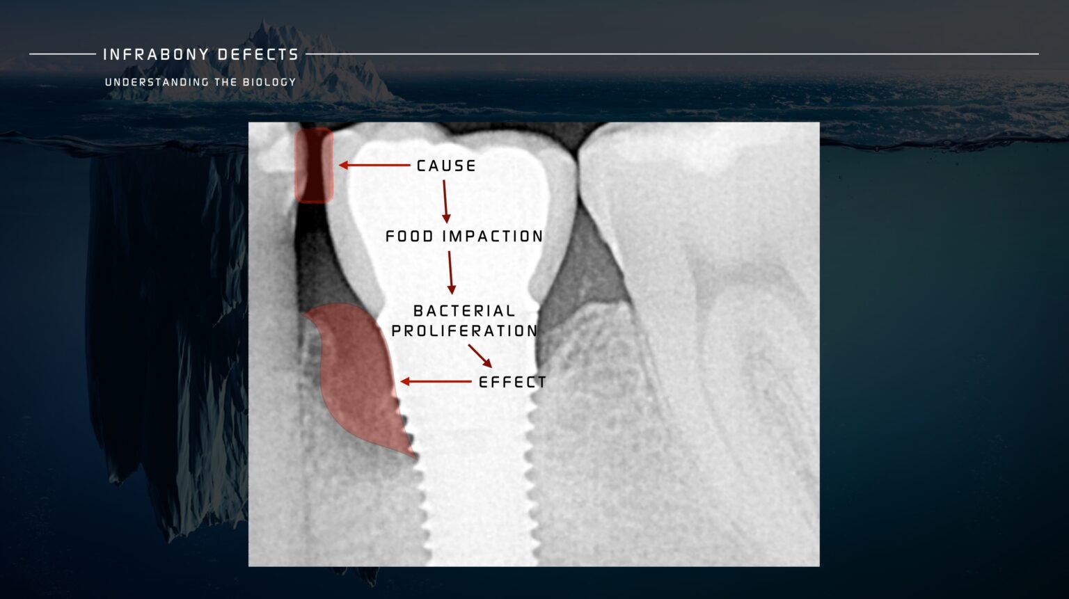 Infrabony Defects. Are we treating the real problem? -The Know how ...