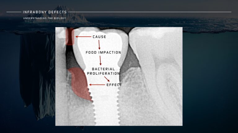 Infrabony Defects. Are We Treating The Real Problem? -the Know How 