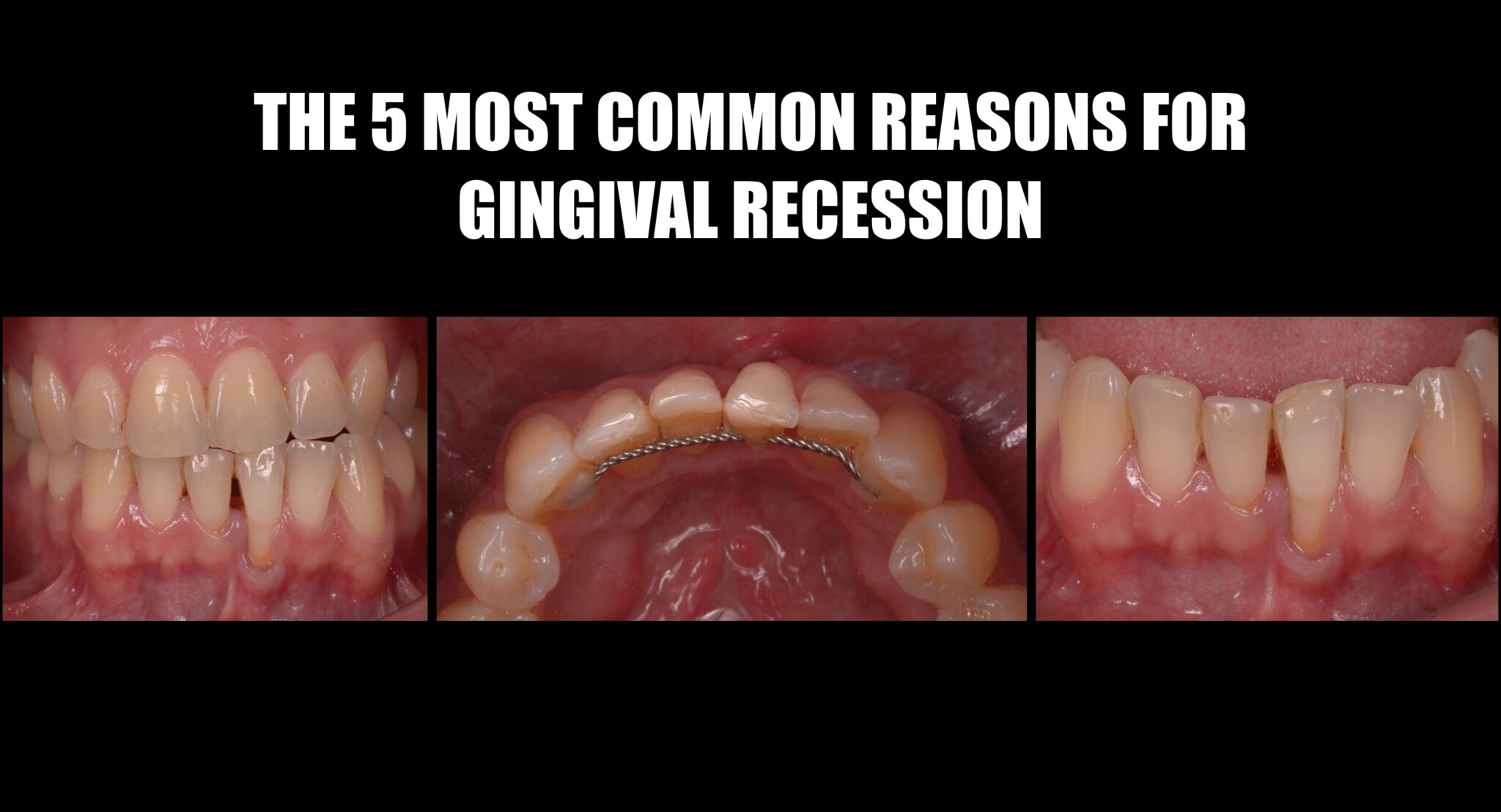 Which Are The Most Common Reasons For Gingival Recession